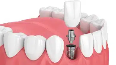 Photo de Que faut-il savoir avant un rendez-vous de prothèse dentaire ?